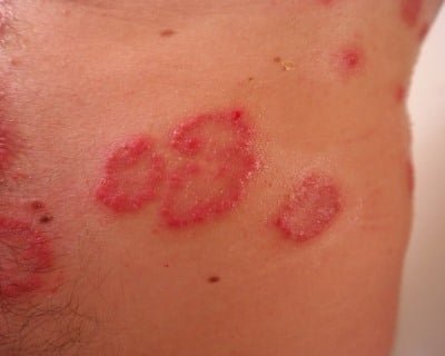 CBD-Öl zur Behandlung von Hautkrankheiten im Fokus. CBD-Öl zur Behandlung