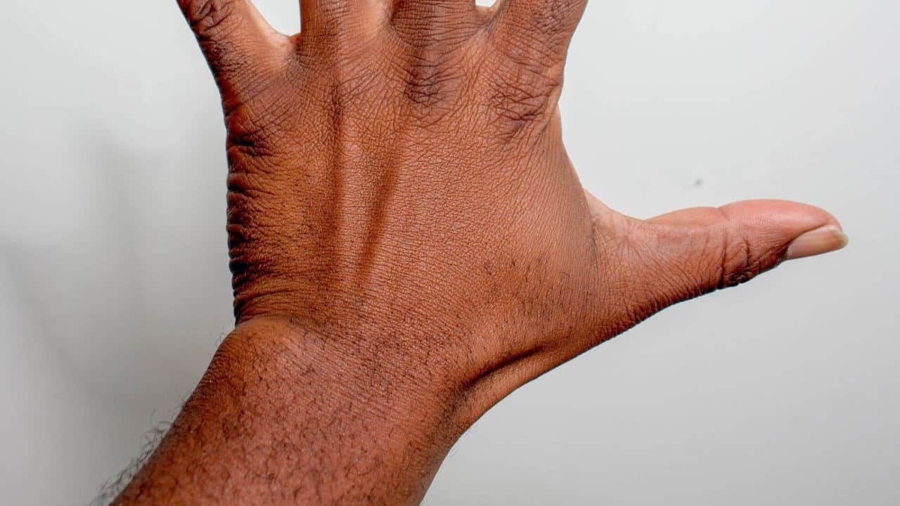 Cannabis bei Karpaltunnelsyndrom