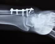 CBD-Studie Knochen Cannabinoide